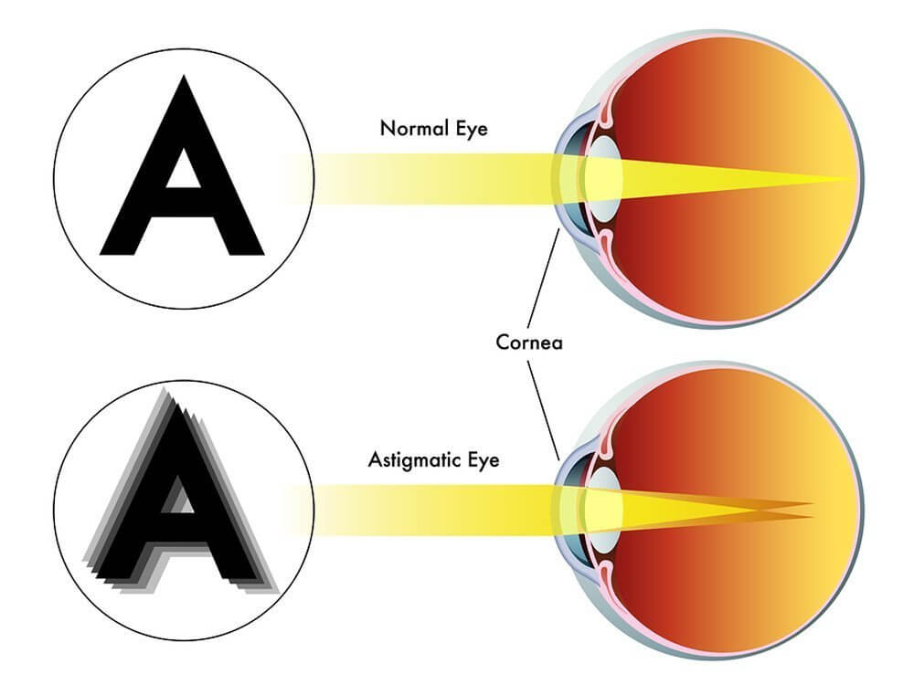 Eye Astigmatism diagram