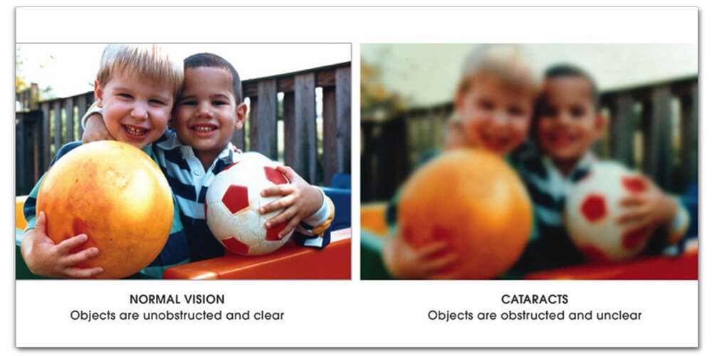 Normal Vision compared to Cataract Vision
