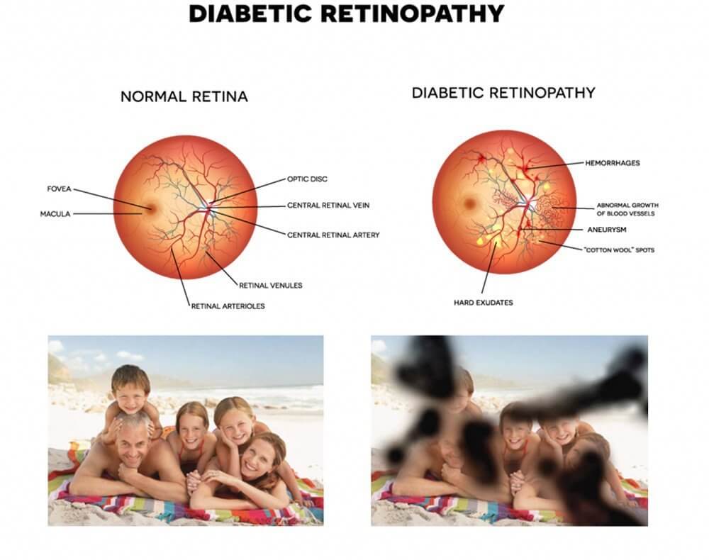 Diabetic Retinopathy effects