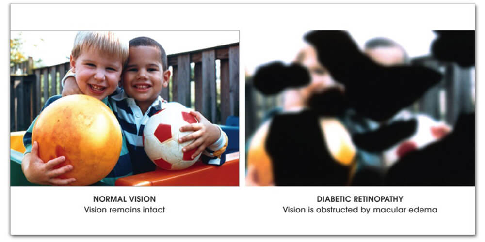 Normal Vision compared to Vision affected by Diabetic Retinopathy