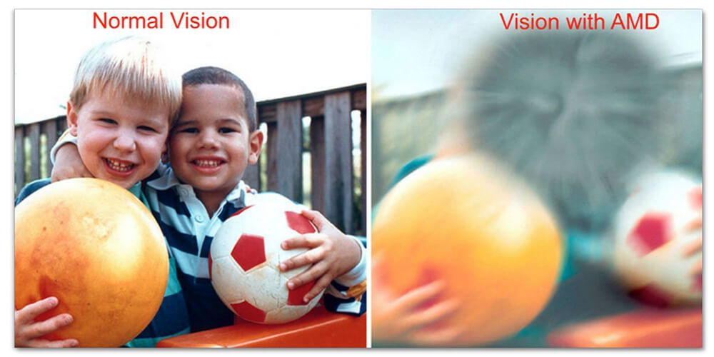 Normal Vision compared with AMD Vision