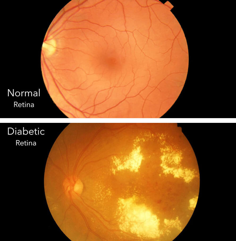 Normal and Diabetic Retina
