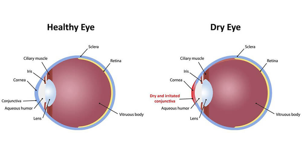 Dry Eye medical illustration